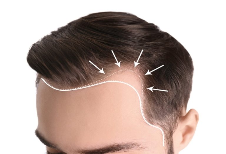 Hair Transplants for Thinning Hair: Is It an Option?