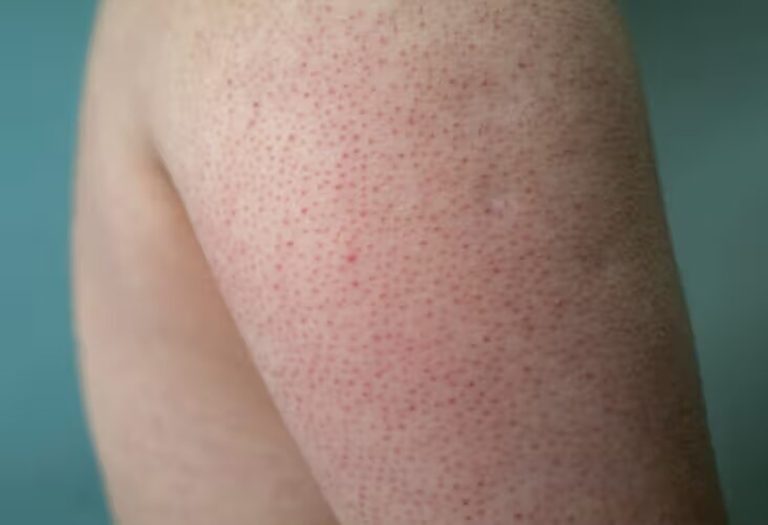 The Best Daily Routine for Managing Keratosis Pilaris: KP Lotions and More