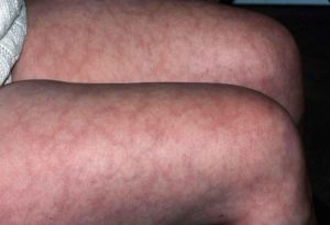 Mottled Patterns