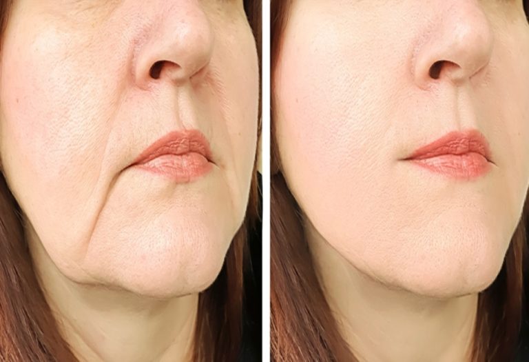Post-Procedure Care: Maximising Results from Fat Transfers