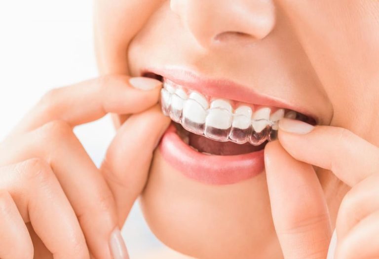 The Benefits of Invisalign Braces for Adults and Teens 