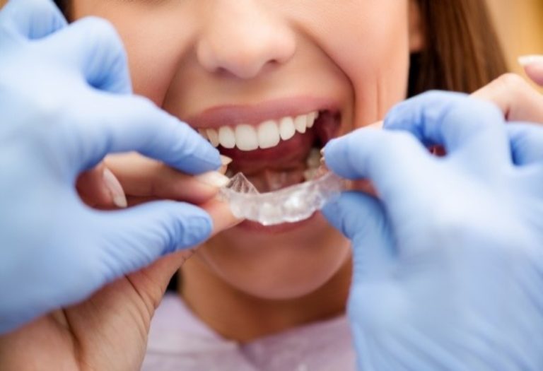 The Magic of Modern Orthodontics: Unveiling the Benefits of Invisalign