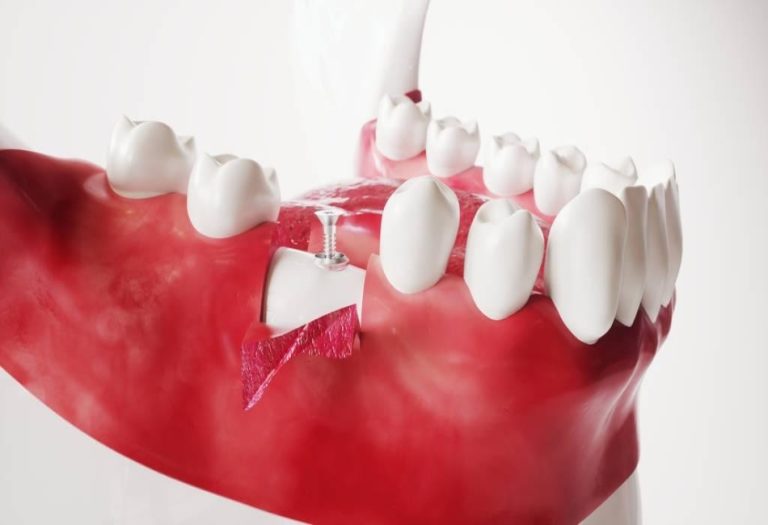 A Comprehensive Guide to Wisdom Teeth Extraction: Key Steps and Tips for Recovery